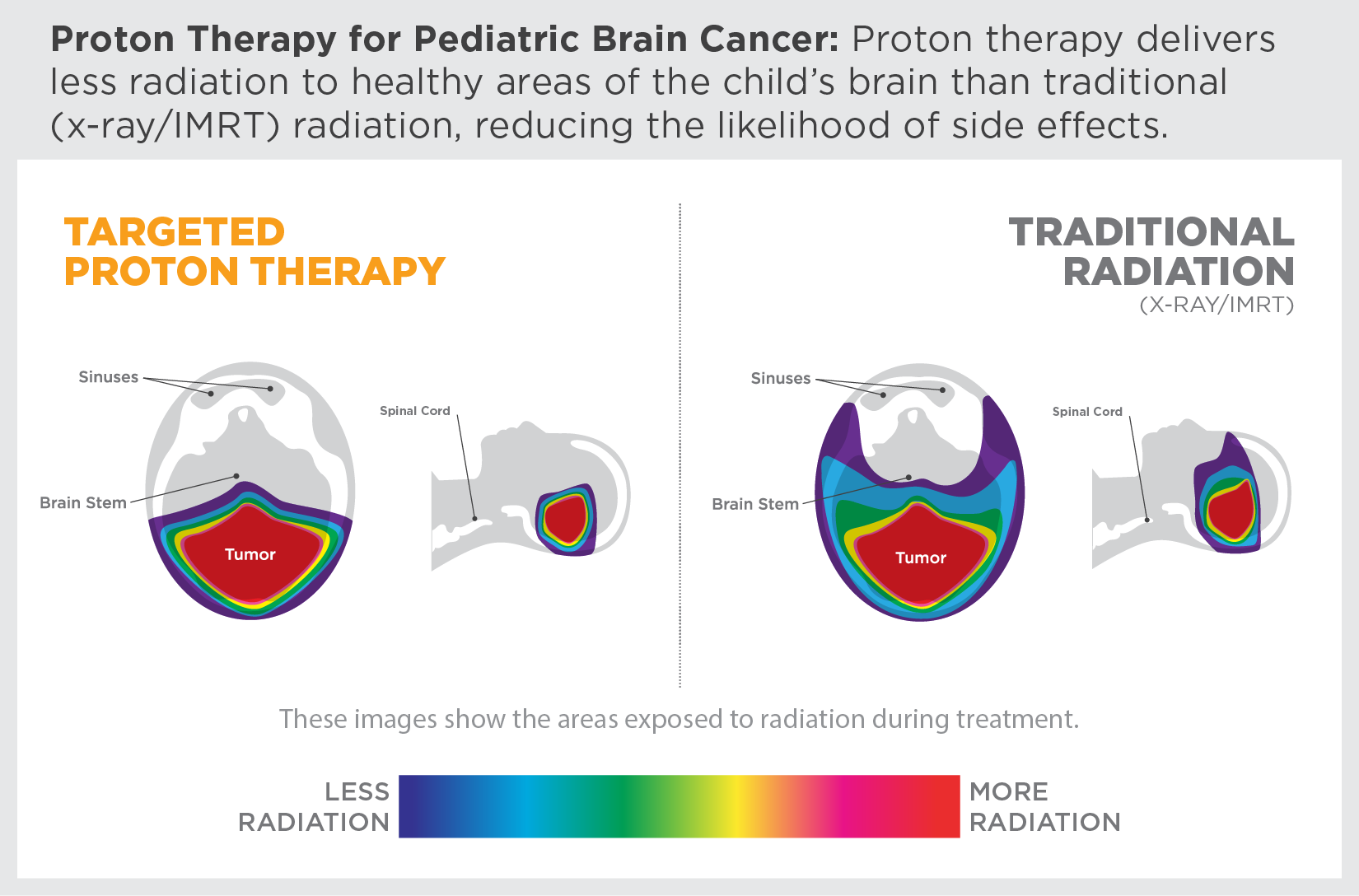 Proton therapy delivers less radiation to healthy areas of the brain, reducing the likelihood of side effects.