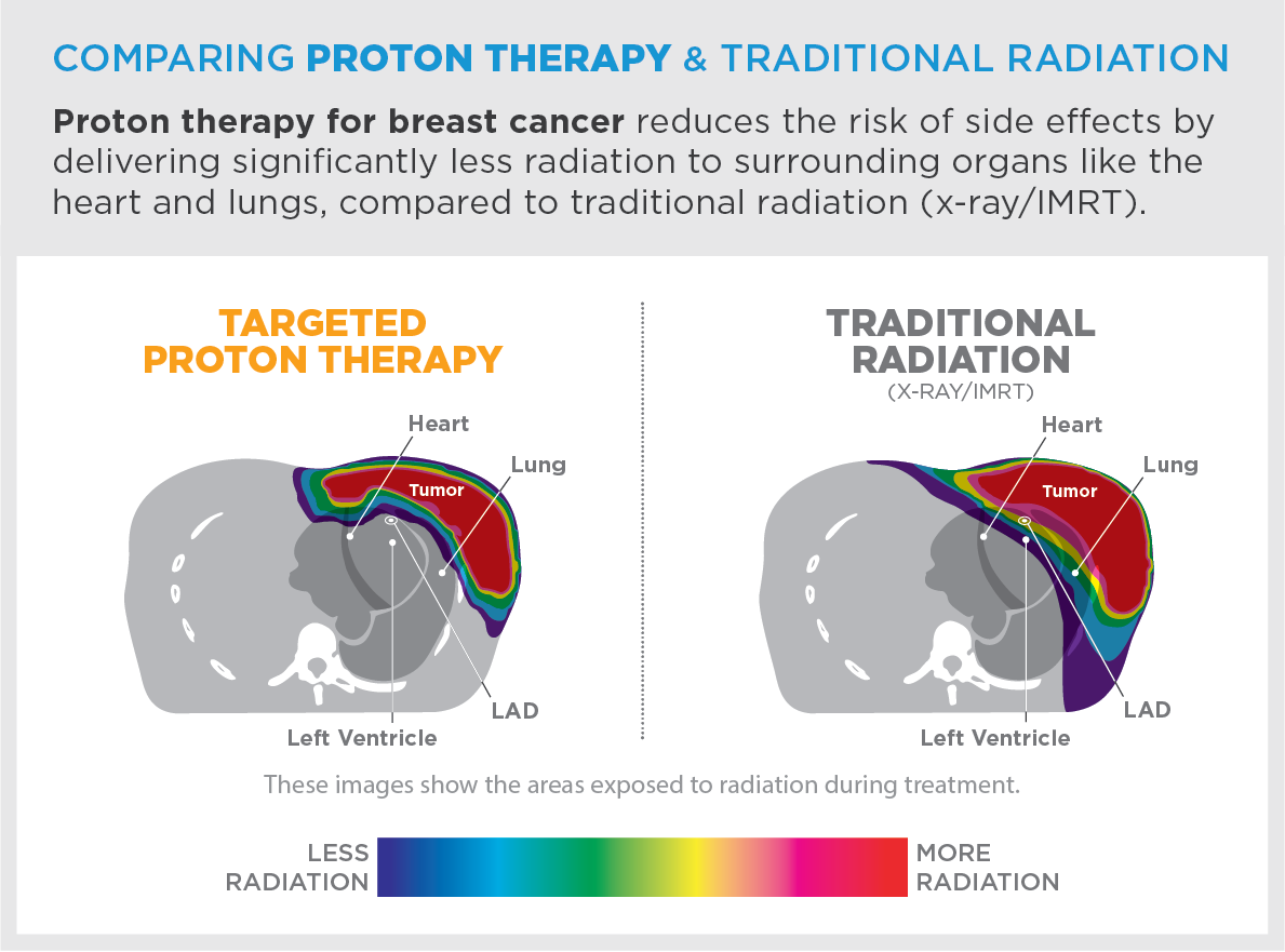 How long does proton therapy for prostate cancer take